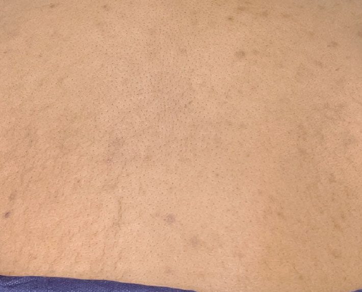Back after VI Peel Body treatment, showing fewer dark spots and more even tone