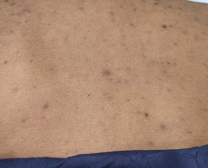 Post-inflammatory hyperpigmentation on the back before VI Peel Body treatment