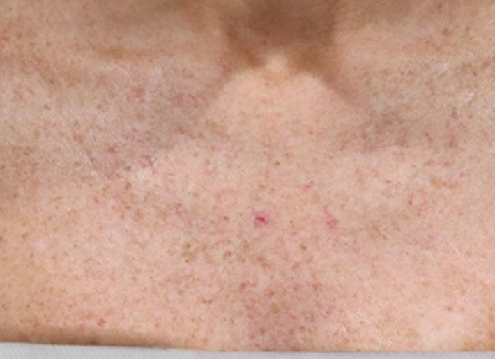 Chest after VI Peel Body treatment, showing more even skin tone