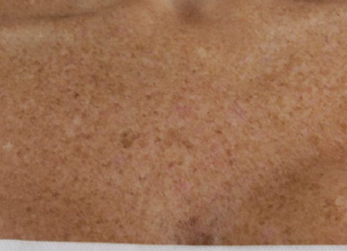 Chest hyperpigmentation and sun damage before VI Peel Body treatment