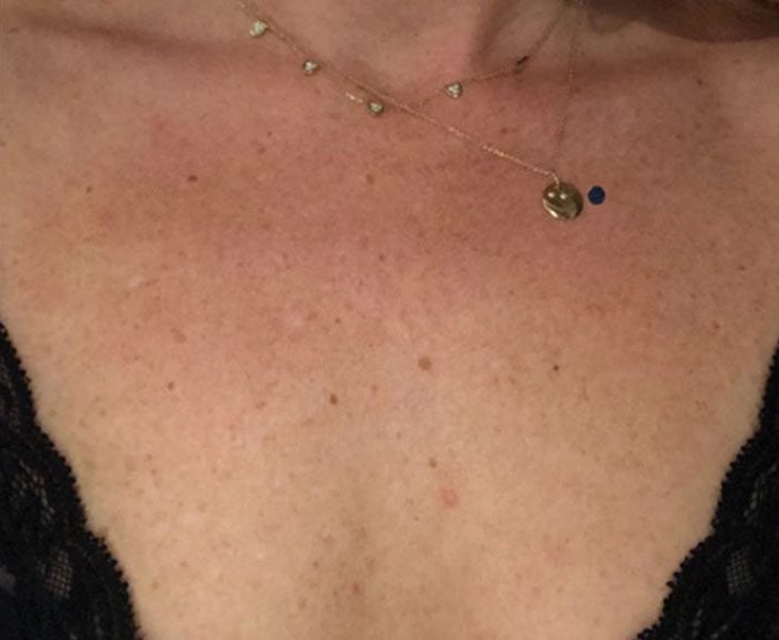 Neck and chest after VI Peel Body treatment, showing more even skin tone