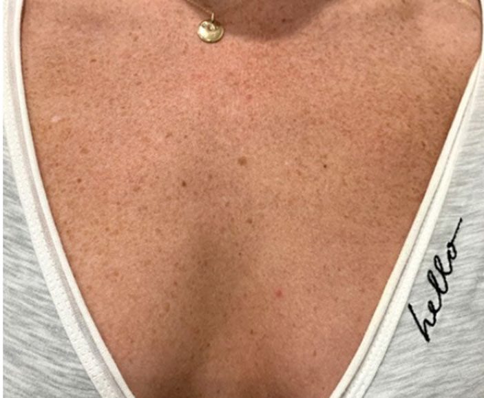 Sun damage and freckling on the neck and chest before VI Peel Body treatment