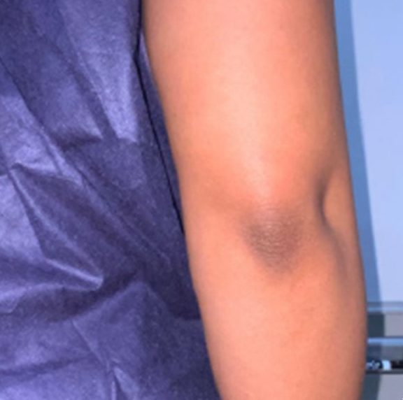 Elbow after VI Peel Body treatment, showing more even skin tone