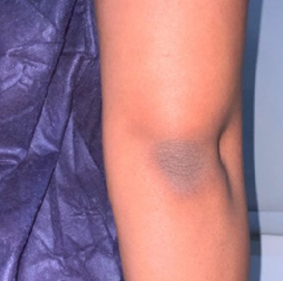 Dark hyperpigmentation on the elbow before VI Peel Body treatment