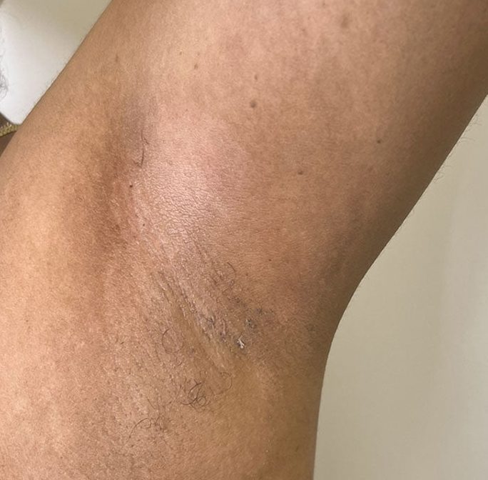 Underarm after VI Peel Body treatment, showing more even skin tone