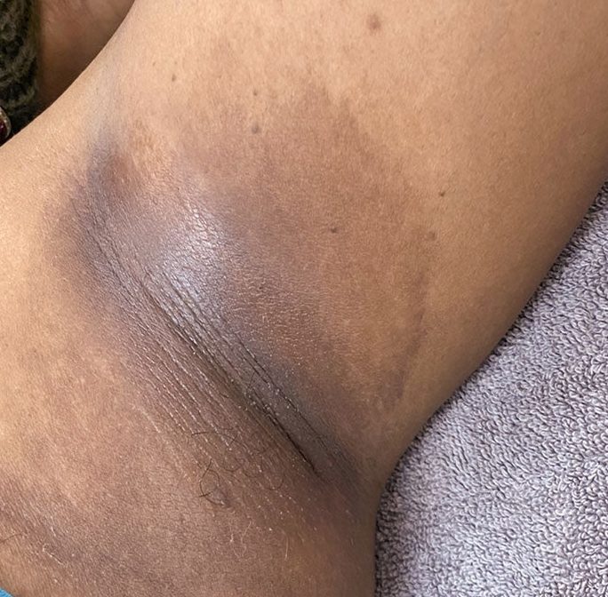 Underarm hyperpigmentation before VI Peel Body treatment