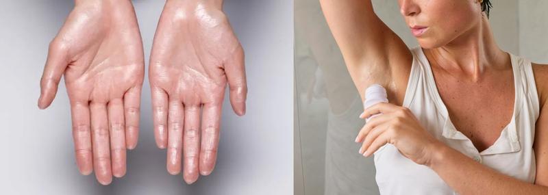 Excessive sweating hyperhidrosis treatment in Brandon FL