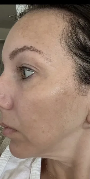 Before BBL and MOXI before and after at Florida Aesthetics and Wellness in Brandon, FL