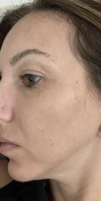 After BBL and MOXI before and after at Florida Aesthetics and Wellness in Brandon, FL