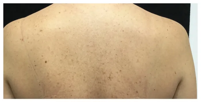 Before BBL and MOXI before and after at Florida Aesthetics and Wellness in Brandon, FL