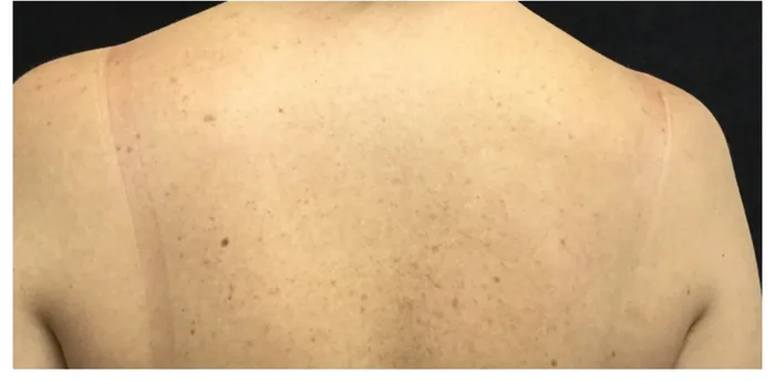 After BBL and MOXI before and after at Florida Aesthetics and Wellness in Brandon, FL