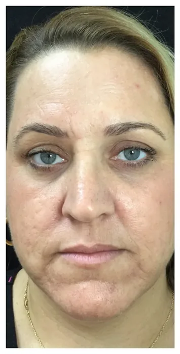 Before BBL and MOXI before and after at Florida Aesthetics and Wellness in Brandon, FL