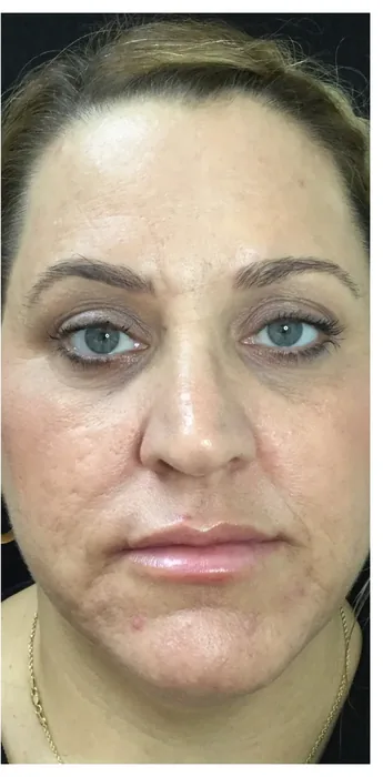 After BBL and MOXI before and after at Florida Aesthetics and Wellness in Brandon, FL