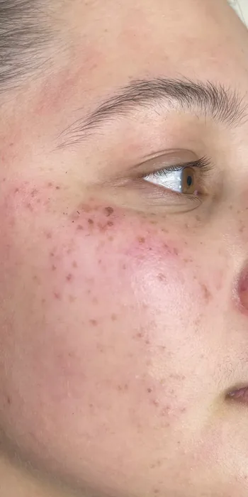 After BBL and MOXI before and after at Florida Aesthetics and Wellness in Brandon, FL