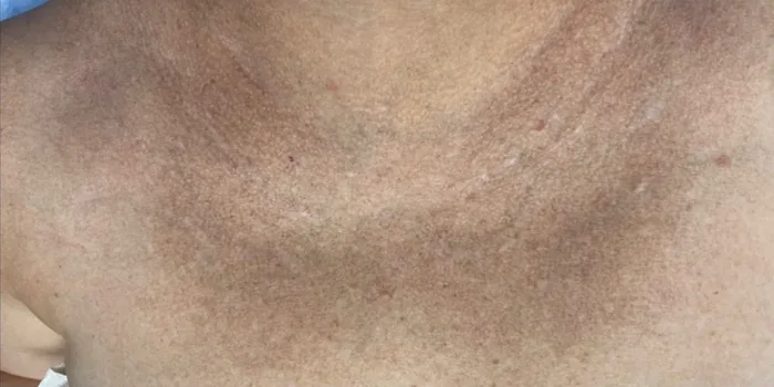 Before BBL and MOXI before and after at Florida Aesthetics and Wellness in Brandon, FL
