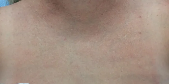 After BBL and MOXI before and after at Florida Aesthetics and Wellness in Brandon, FL