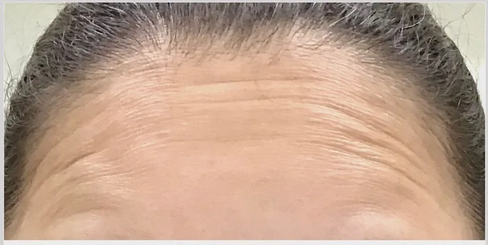 Before Botox before and after at Florida Aesthetics and Wellness in Brandon, FL