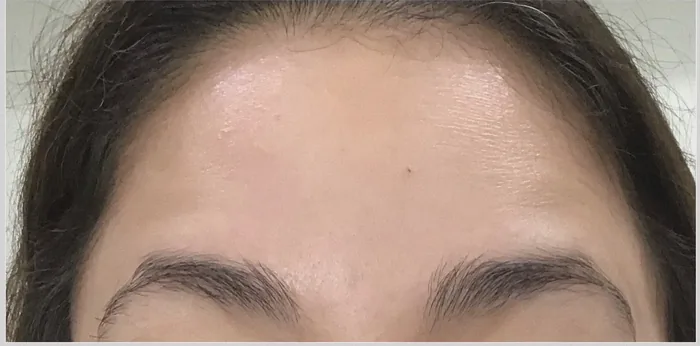 After Botox before and after at Florida Aesthetics and Wellness in Brandon, FL