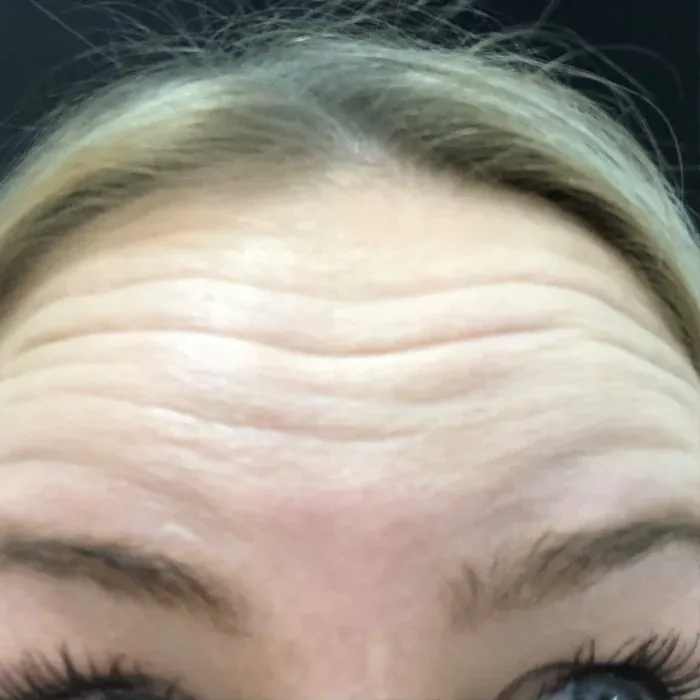 Before Botox before and after at Florida Aesthetics and Wellness in Brandon, FL