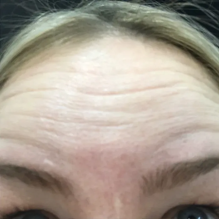 After Botox before and after at Florida Aesthetics and Wellness in Brandon, FL