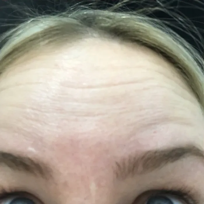 Before Botox before and after at Florida Aesthetics and Wellness in Brandon, FL