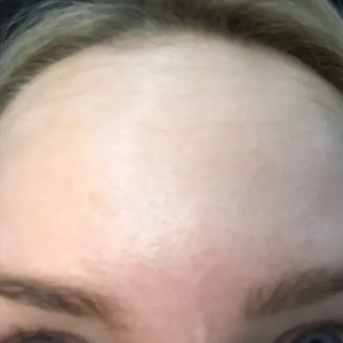 After Botox before and after at Florida Aesthetics and Wellness in Brandon, FL