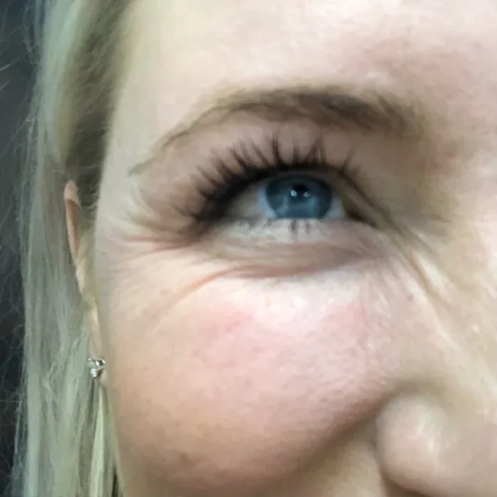 Before Botox before and after at Florida Aesthetics and Wellness in Brandon, FL