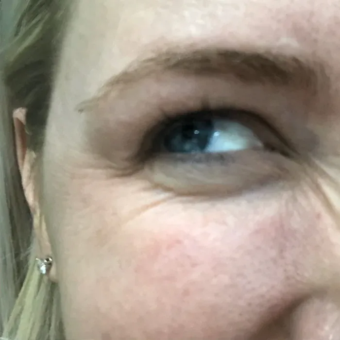 After Botox before and after at Florida Aesthetics and Wellness in Brandon, FL
