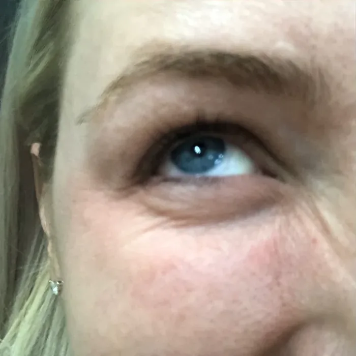 Before Botox before and after at Florida Aesthetics and Wellness in Brandon, FL