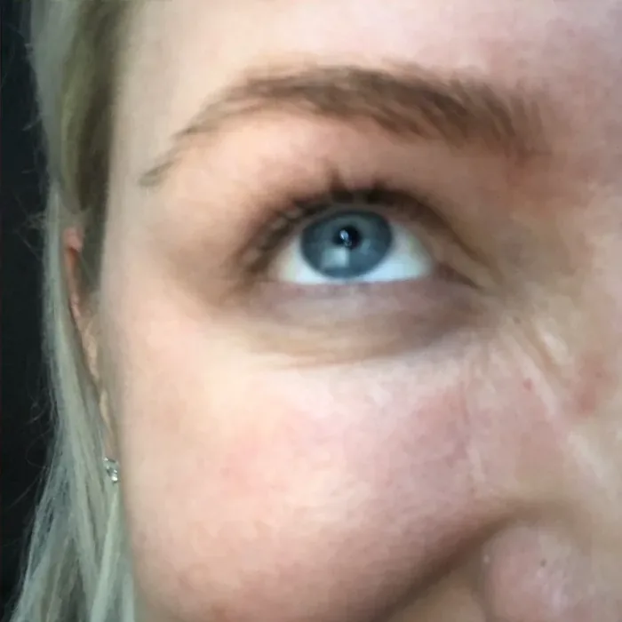 After Botox before and after at Florida Aesthetics and Wellness in Brandon, FL