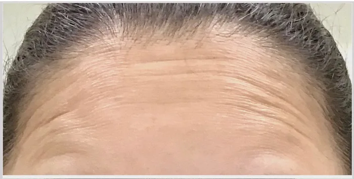 Before Botox before and after at Florida Aesthetics and Wellness in Brandon, FL