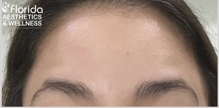 After Botox before and after at Florida Aesthetics and Wellness in Brandon, FL
