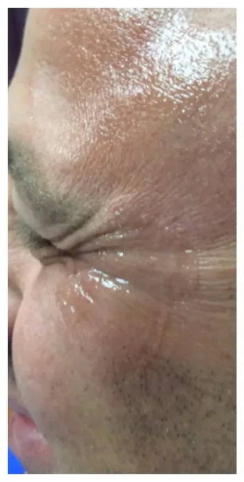 Before Botox before and after at Florida Aesthetics and Wellness in Brandon, FL