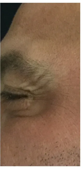 After Botox before and after at Florida Aesthetics and Wellness in Brandon, FL