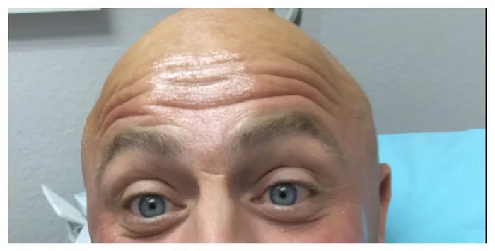 Before Botox before and after at Florida Aesthetics and Wellness in Brandon, FL