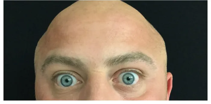 After Botox before and after at Florida Aesthetics and Wellness in Brandon, FL