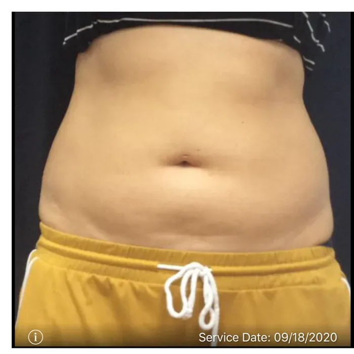 Before CoolSculpting before and after at Florida Aesthetics and Wellness in Brandon, FL