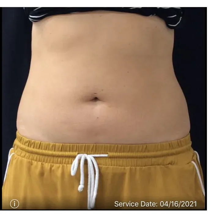 After CoolSculpting before and after at Florida Aesthetics and Wellness in Brandon, FL