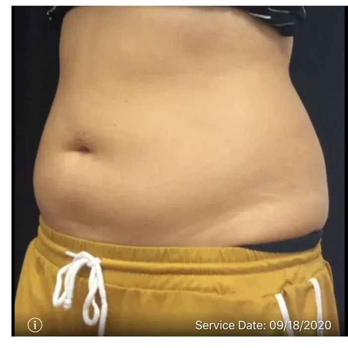 Before CoolSculpting before and after at Florida Aesthetics and Wellness in Brandon, FL