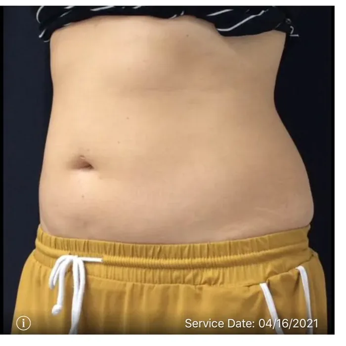 After CoolSculpting before and after at Florida Aesthetics and Wellness in Brandon, FL