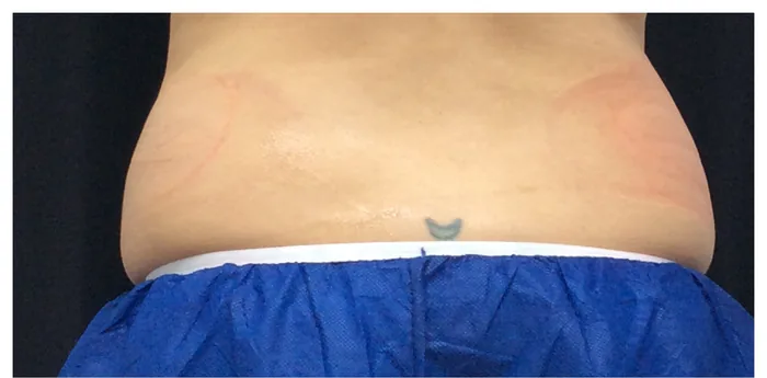 Before CoolSculpting before and after at Florida Aesthetics and Wellness in Brandon, FL
