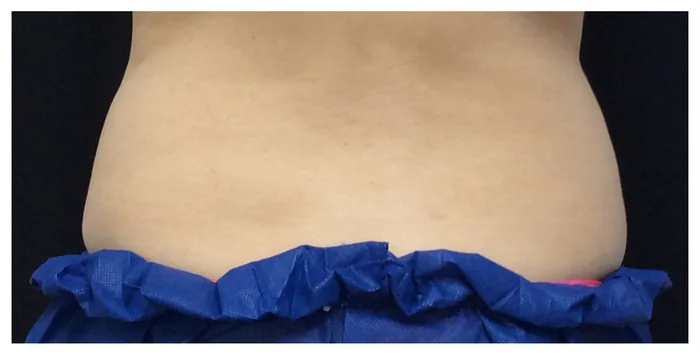 After CoolSculpting before and after at Florida Aesthetics and Wellness in Brandon, FL
