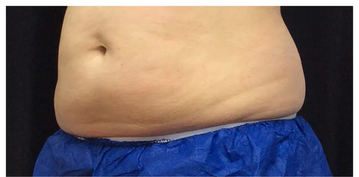 Before CoolSculpting before and after at Florida Aesthetics and Wellness in Brandon, FL