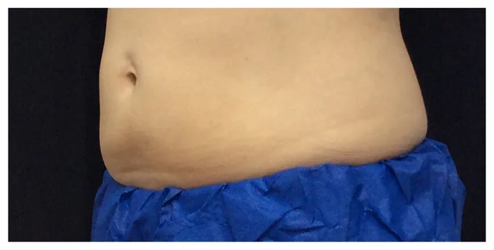 After CoolSculpting before and after at Florida Aesthetics and Wellness in Brandon, FL