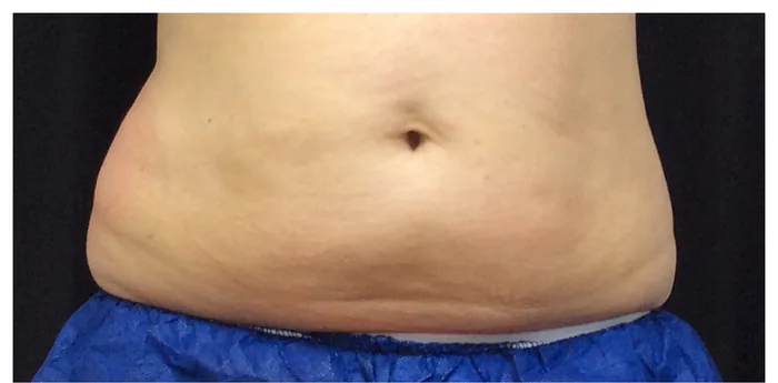 Before CoolSculpting before and after at Florida Aesthetics and Wellness in Brandon, FL
