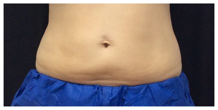 After CoolSculpting before and after at Florida Aesthetics and Wellness in Brandon, FL