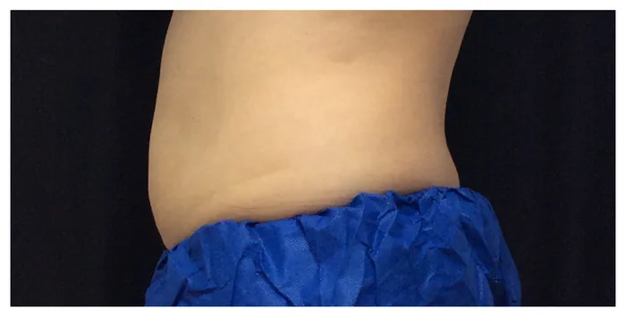 After CoolSculpting before and after at Florida Aesthetics and Wellness in Brandon, FL