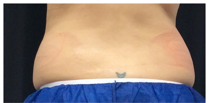Before CoolSculpting before and after at Florida Aesthetics and Wellness in Brandon, FL