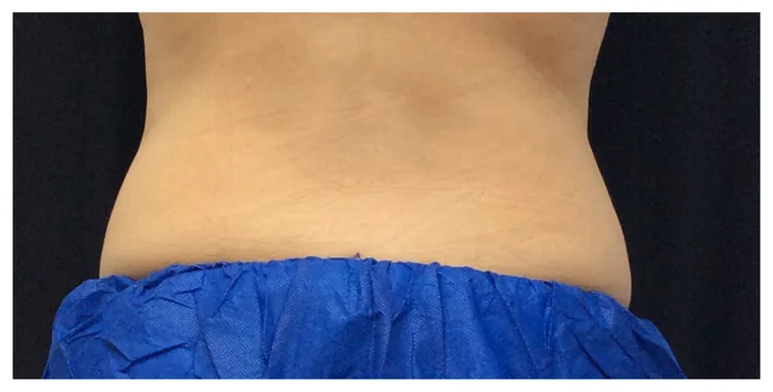 After CoolSculpting before and after at Florida Aesthetics and Wellness in Brandon, FL