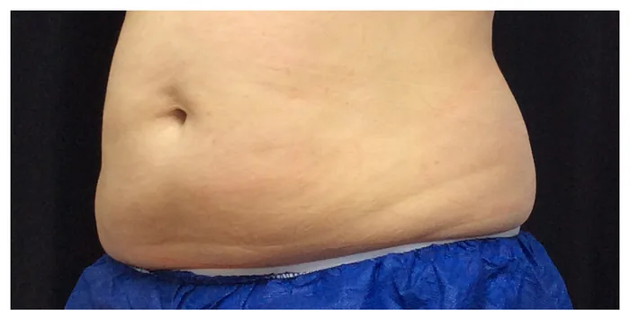 Before CoolSculpting before and after at Florida Aesthetics and Wellness in Brandon, FL